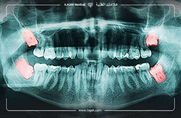 abces dentaire - diagnostic au rayon x