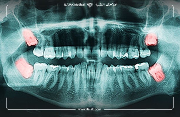 كيف افقع خراج الأسنان