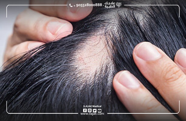 la pelade - alopecie areata