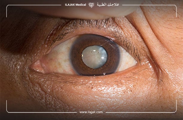علاج المياه البيضاء في العين بدون جراحة