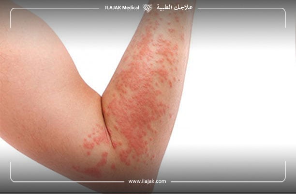 eczema main