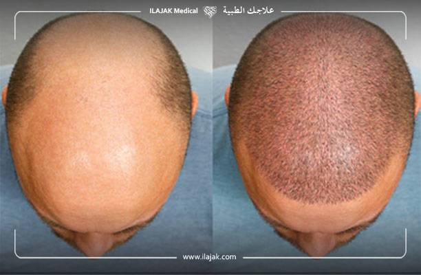 أفضل علاج لتساقط الشعر