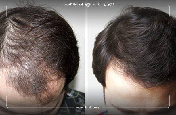 أفضل علاج لتساقط الشعر