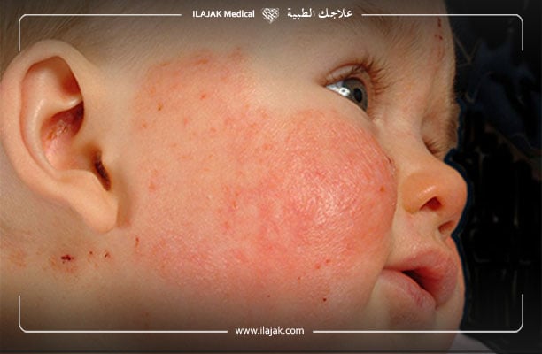 eczema bebe