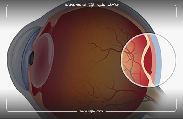 اعراض انفصال الشبكية