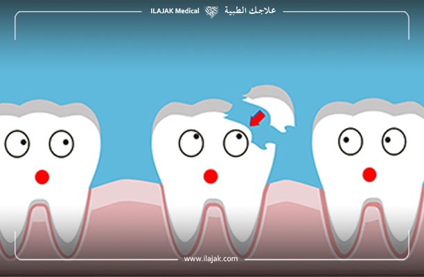 علاج تفتت الأسنان