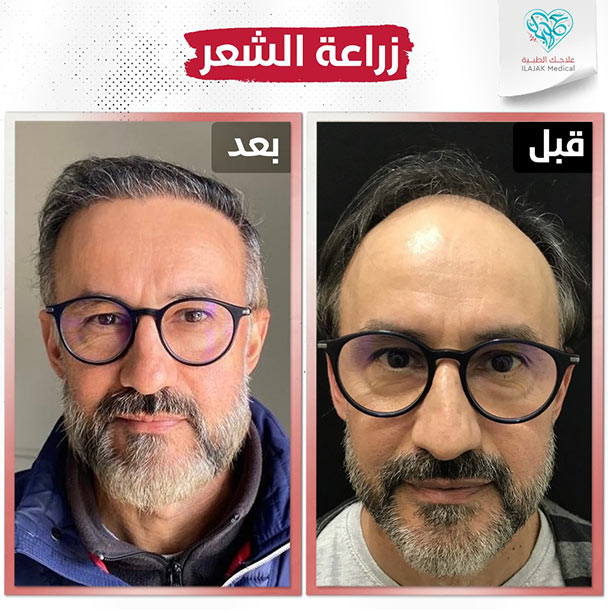 زراعة الشعر باقلام تشوي قبل وبعد