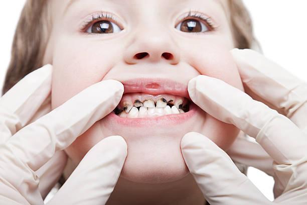  أسباب تسوس الأسنان عند الأطفال