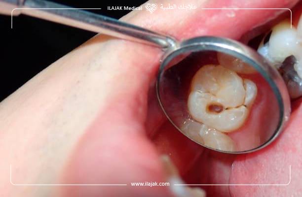أنواع تسوس الأسنان بالصور