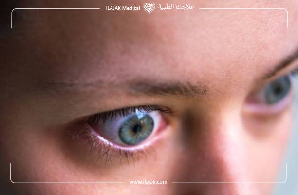 مرض جريفز