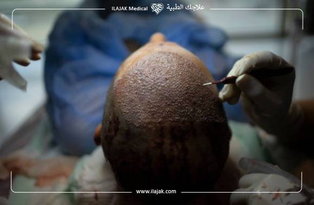 فشل زراعة الشعر