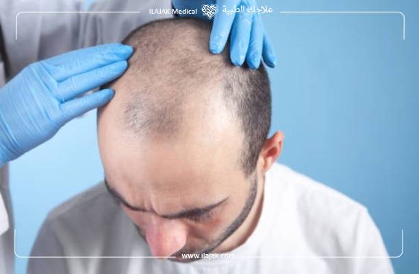 أسباب فشل عملية زراعة الشعر