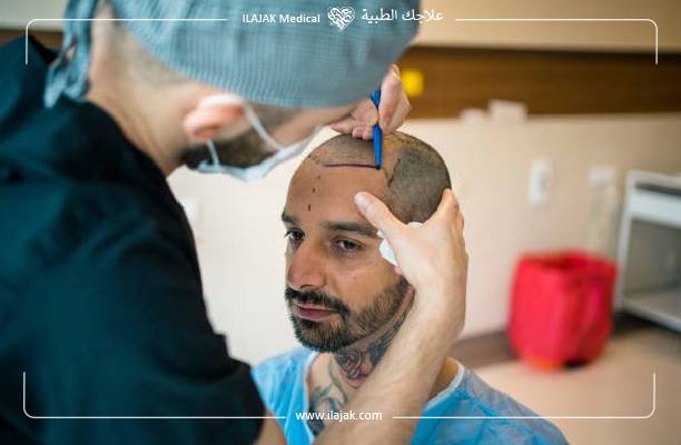 نتائج زراعة الشعر