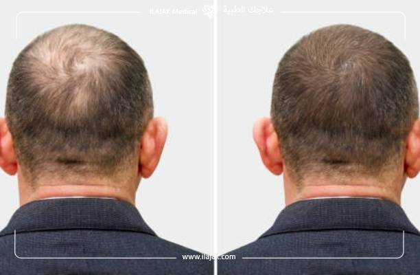 تجربة زراعة الشعر في تركيا