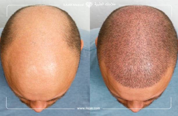 نتائج عملية زراعة الشعر