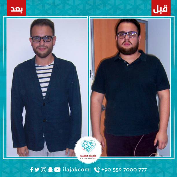 تجارب تكميم ناجحه