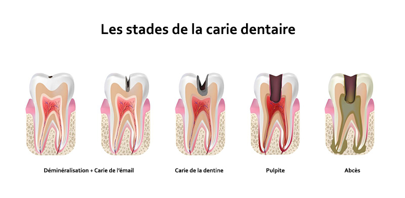 debut carie dentaire