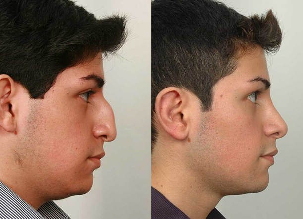 Rhinoplastie Avant Après