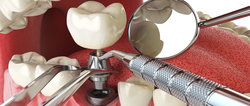 Dental implants