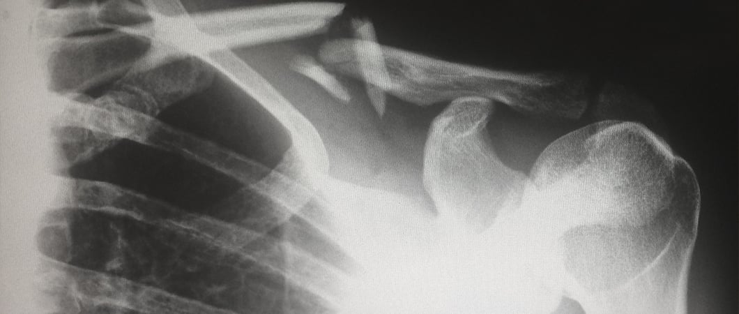 Shoulder Surgery in Turkey