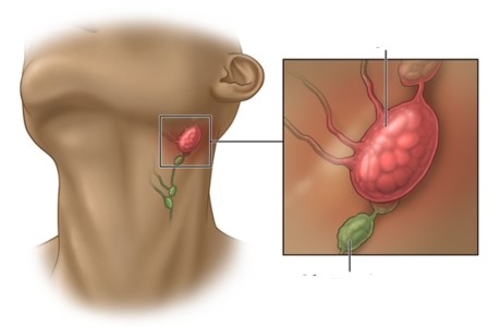 Radiothérapie aux ganglions lymphatiques