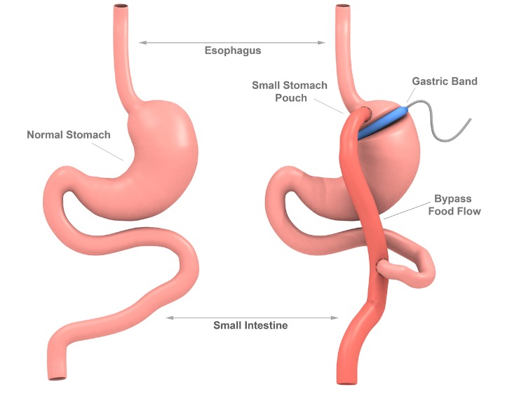 gastric bypass