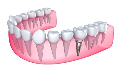 Implant immédiat