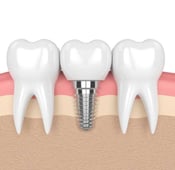استخدامات مادة التيتانيوم وفوائدها في طب الأسنان