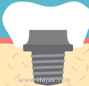 انواع زارعة الأسنان في تركيا  مراحلها ومميزاتها
