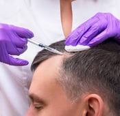 What is shock loss after hair transplant ?