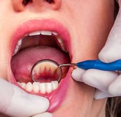 تنظيف اللثة العميق: كيف يتم وماهي أسعاره؟