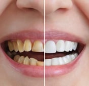 ما هو تجميل الأسنان وما هي أشهر أنواعه؟