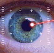 Laser eye surgery turkey reviews  2024