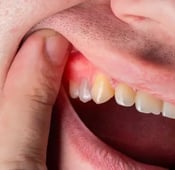 أسباب وأعراض ناسور الأسنان وكيفية علاجه