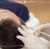 Injection de PRP pour cheveux : Ce qu'il faut savoir