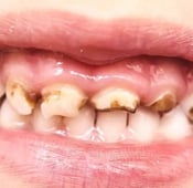 أنواع تسوس الأسنان بالصور