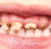 أخطر أنواع تسوس الأسنان بالصور