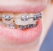 دليل أسعار تقويم الأسنان في تركيا مقارنة مع عدة دول