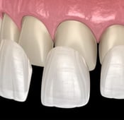 فينير الأسنان المتحرك: المميزات والعيوب والأسعار