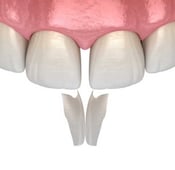 ما هو ترابط الأسنان وكيف يتم؟