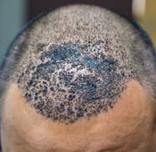 ما هي أهم علامات فشل زراعة الشعر وكيف تتجنبها؟