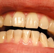 Les dents jaunes: causes et traitement