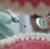 أسعار تجميل الأسنان في عدة دول: دراسة مقارنة