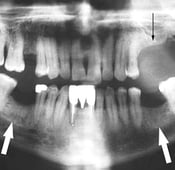 7 أسباب لتآكل عظام الفك: كيفية الوقاية والعلاج