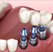 Dental Implant Failure: Signs, Causes, and Treatment