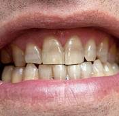 أنواع تصبغات الأسنان: الأسباب والعلاج