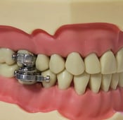 ربط الأسنان للتنحيف: حقيقة أم خيال