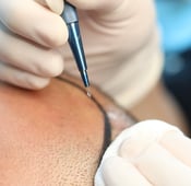 تقنية السفير لزراعة الشعر في تركيا: المزايا والتكاليف