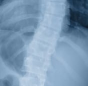 Scoliosis treatment and surgery