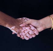 Le vitiligo : symptômes, causes et traitement